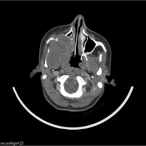 File:Carcinoma of the maxillary antrum (Radiopaedia 53805-59888 Axial C+ delayed 52).jpg