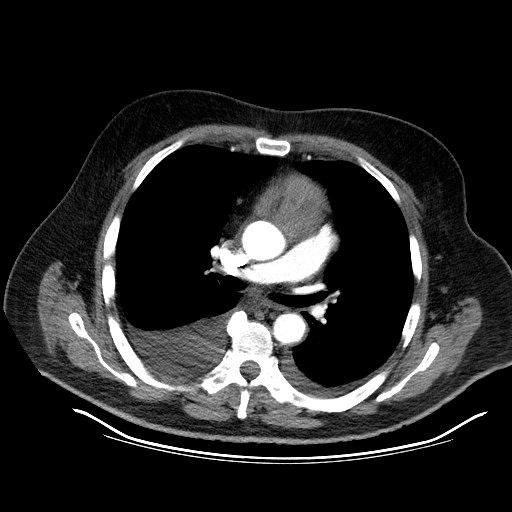 File:Cardiac lymphoma (Radiopaedia 38690-40836 Axial C+ CTPA 7).jpg