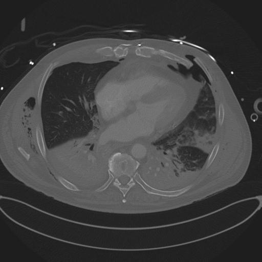 Cardiac trauma (Radiopaedia 32874-33858 Axial bone window 57).jpg