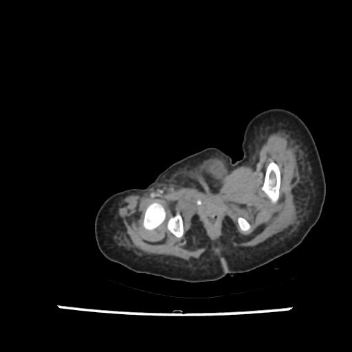 File:Caroli disease with autosomal recessive polycystic kidney disease (ARPKD) (Radiopaedia 89651-106703 B 237).jpg
