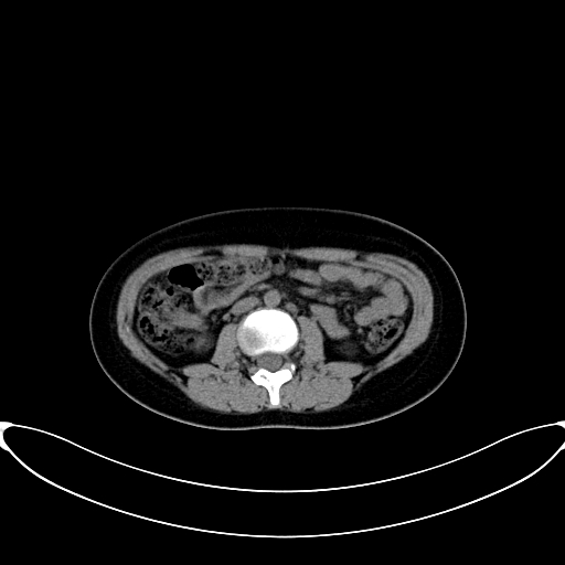 Caroli disease with medullary sponge kidney (Radiopaedia 82622-96804 Axial non-contrast 36).jpg