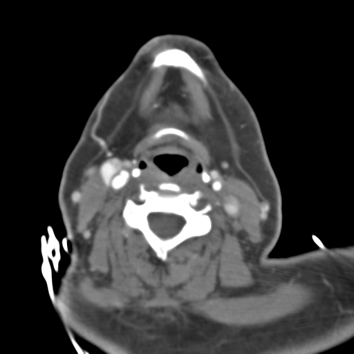File:Carotico ophthalmic aneurysm (Radiopaedia 42916-46148 A 71).png