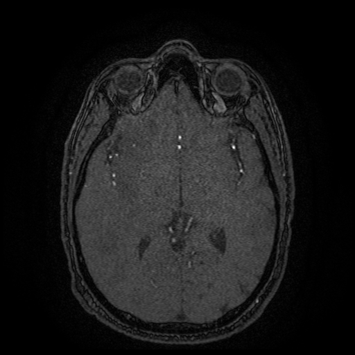 Carotid arterial dissection with acute cerebral infarction (Radiopaedia 26636-26784 MRA 83).jpg