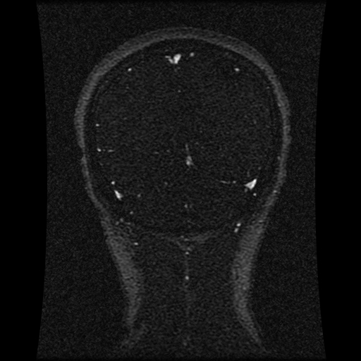 Carotid arterial dissection with acute cerebral infarction (Radiopaedia 26636-26784 MRV 56).jpg