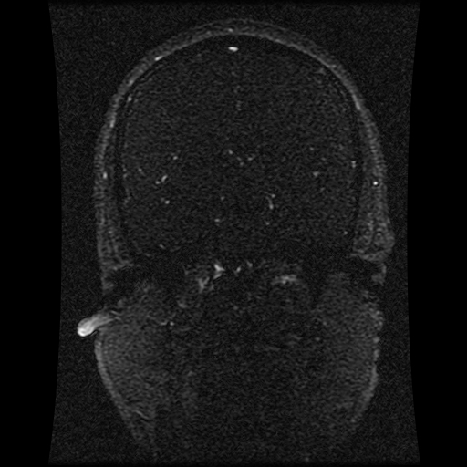 Carotid arterial dissection with acute cerebral infarction (Radiopaedia 26636-26784 MRV 97).jpg