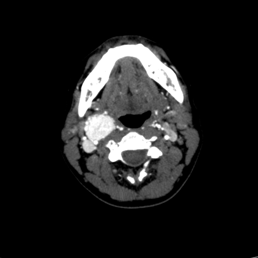 File:Carotid body tumor (Radiopaedia 39845-42300 B 42).jpg
