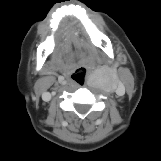 Carotid body tumor (paraganglioma) (Radiopaedia 38586-40729 A 17).jpg