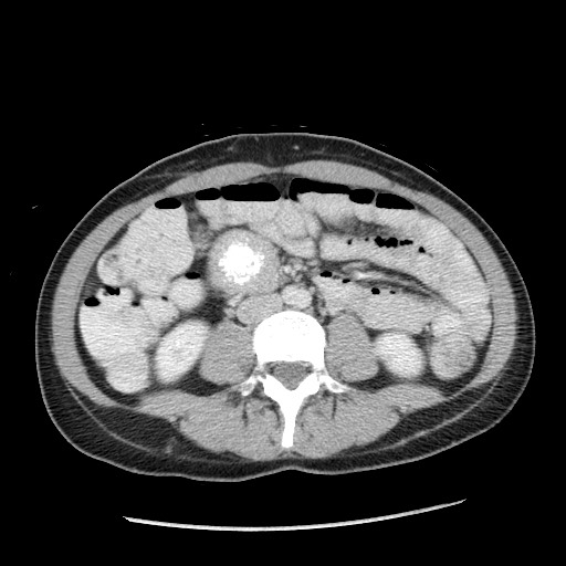 Castleman disease with fibrous pseudotumor in the abdomen (Radiopaedia 77296-89373 A 68).jpg