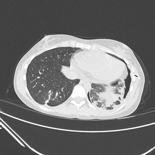 Catamenial pneumothorax (Radiopaedia 27946-28197 lung window 120).jpg