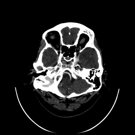 Cavernoma with developmental venous anomaly (Radiopaedia 22470-22506 C 18).jpg