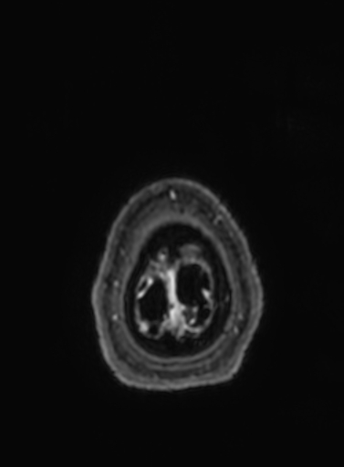 File:Cavernous hemangioma of the cerebellar falx (Radiopaedia 73025-83724 Axial T1 C+ 17).jpg