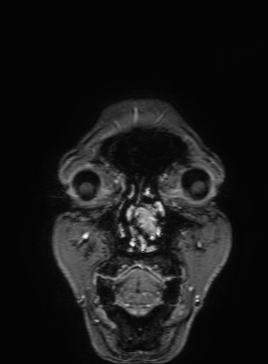 Cavernous hemangioma of the cerebellar falx (Radiopaedia 73025-83724 Coronal T1 C+ 19).jpg