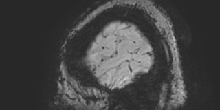File:Cavernous hemangioma of the cerebellar falx (Radiopaedia 73025-83724 Sagittal BOLD 13).jpg