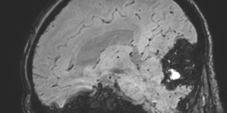 Cavernous hemangioma of the cerebellar falx (Radiopaedia 73025-83724 Sagittal BOLD 88).jpg
