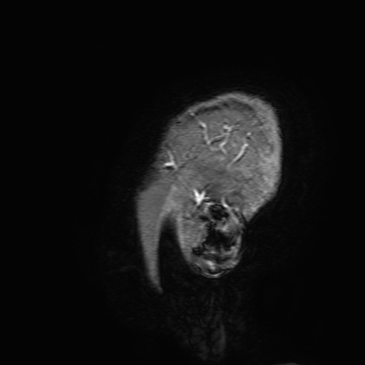 Cavernous hemangioma of the cerebellar falx (Radiopaedia 73025-83724 Sagittal T1 C+ 211).jpg