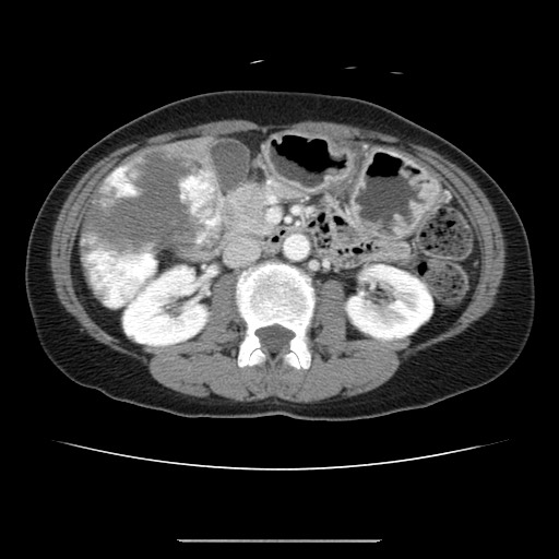 Cavernous hepatic hemangioma (Radiopaedia 75441-86667 B 51).jpg