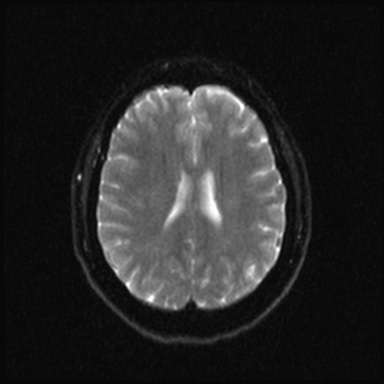 File:Cavernous sinus meningioma (Radiopaedia 63682-72367 DWI 15).jpg