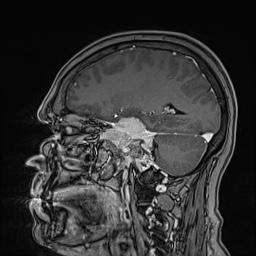 Cavernous sinus meningioma (Radiopaedia 63682-72367 Sagittal T1 C+ 69).jpg