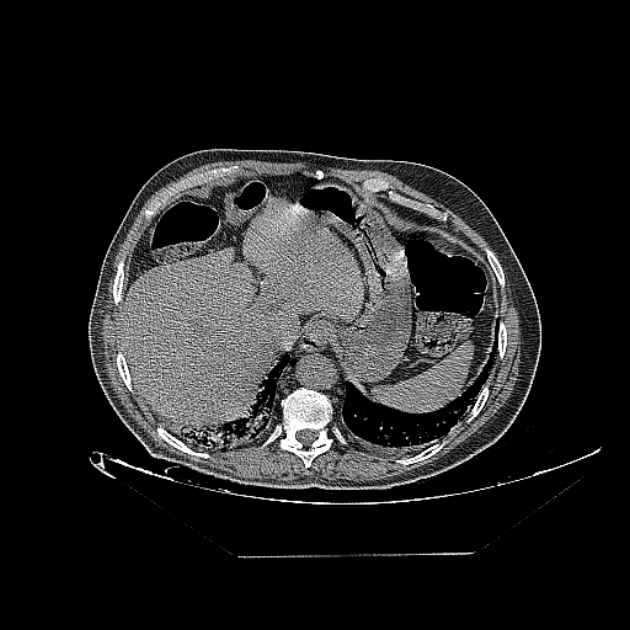 Cavitating bronchogenic carcinoma (Radiopaedia 44489-48162 Axial non-contrast 77).jpg