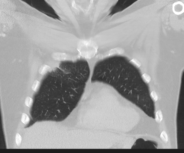 File:Cavitating pneumonia (Radiopaedia 45998-50329 Coronal lung window 12).png