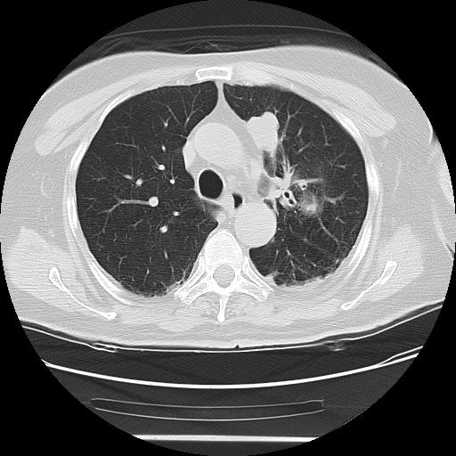 Cavitating pulmonary metastases (Radiopaedia 89545-106544 Axial lung window 20).jpg