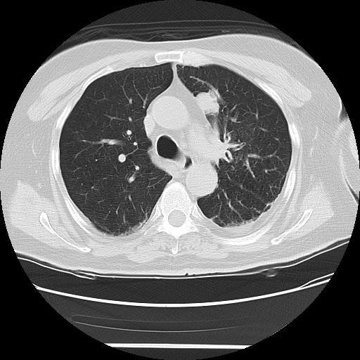 Cavitating pulmonary metastases (Radiopaedia 89545-106544 Axial lung window 21).jpg