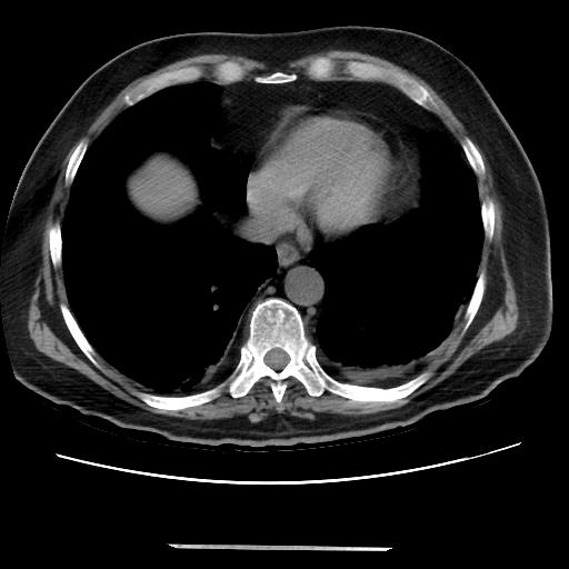 Cavitating pulmonary metastases (Radiopaedia 89545-106544 Axial non-contrast 41).jpg