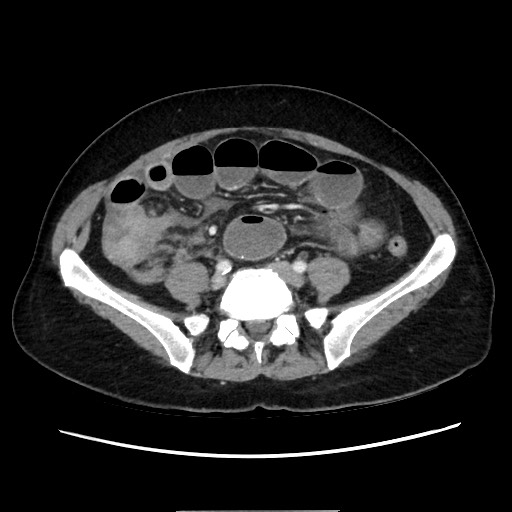Cecal adenocarcinoma (Radiopaedia 75909-87331 A 60).jpg
