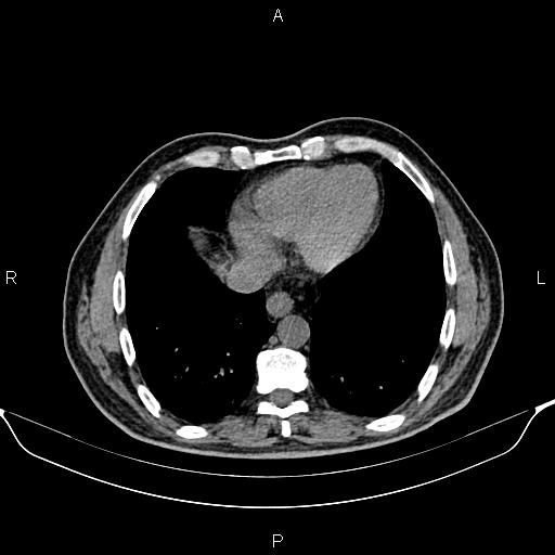 Cecal adenocarcinoma (Radiopaedia 85324-100916 Axial non-contrast 6).jpg