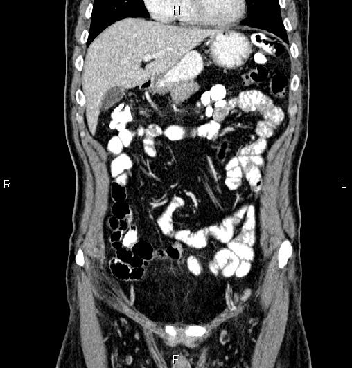 Cecal adenocarcinoma (Radiopaedia 85324-100916 D 18).jpg