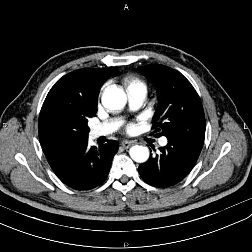 File:Cecal cancer with appendiceal mucocele (Radiopaedia 91080-108651 A 33).jpg