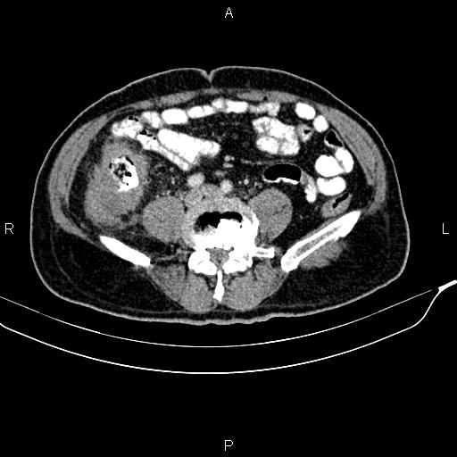 Cecal cancer with appendiceal mucocele (Radiopaedia 91080-108651 B 69).jpg