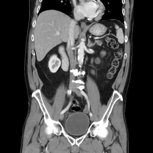 Cecal mass causing appendicitis (Radiopaedia 59207-66531 B 27).jpg