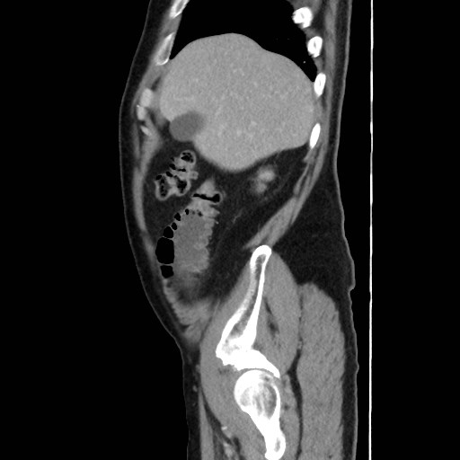 Cecal mass causing appendicitis (Radiopaedia 59207-66531 C 11).jpg