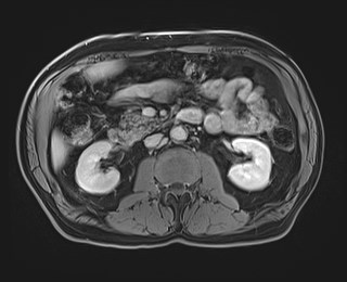 Cecal mass causing appendicitis (Radiopaedia 59207-66532 J 63).jpg
