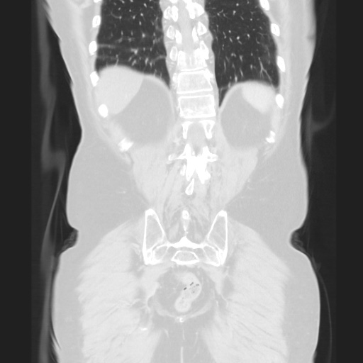 Cecal volvulus (Radiopaedia 75378-86620 Coronal lung window 111).jpg