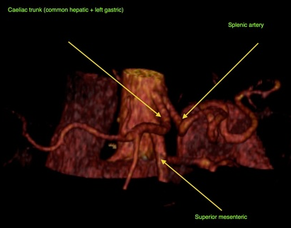 File:Celiac trunk variant anatomy - gastrohepatic trunk and splenic artery (Radiopaedia 38815-40996 A 1).png