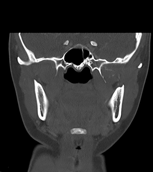 File:Cemento-ossifying fibroma (Radiopaedia 46243-50643 Coronal bone window 31).png