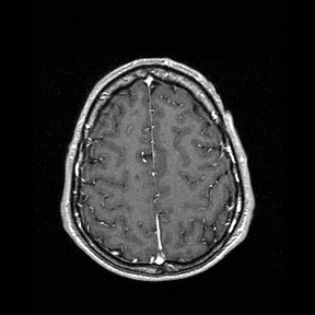 File:Central-variant posterior reversible encephalopathy syndrome (PRES) (Radiopaedia 43880-47358 Axial T1 C+ 135).jpg