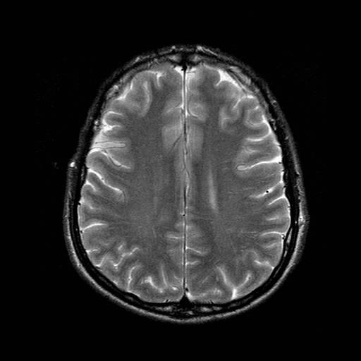 File:Central-variant posterior reversible encephalopathy syndrome (PRES) (Radiopaedia 43880-47359 Axial T2 16).jpg