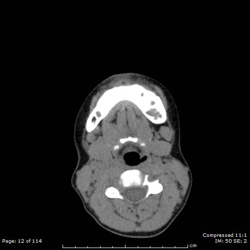 Central giant cell granuloma (Radiopaedia 45612-49754 Axial non-contrast 6).jpg