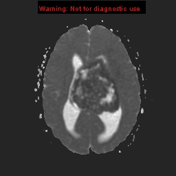 File:Central neurocytoma (Radiopaedia 13188-13206 Axial ADC 1).jpg