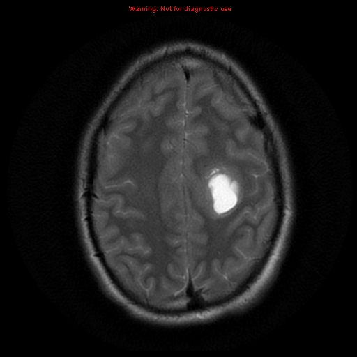 File:Central neurocytoma (Radiopaedia 13188-13206 Axial T2 8).jpg