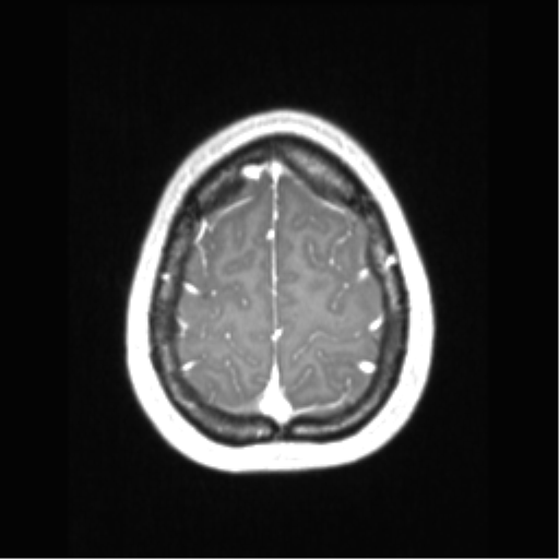 Central neurocytoma (Radiopaedia 37664-39557 Axial T1 C+ 69).png