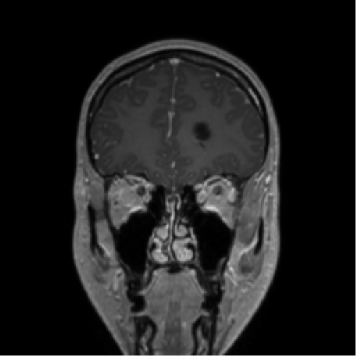 Central neurocytoma (Radiopaedia 37664-39557 Coronal T1 C+ 69).png