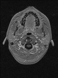 Central neurocytoma (Radiopaedia 56690-63469 Axial T1 C+ 8).jpg
