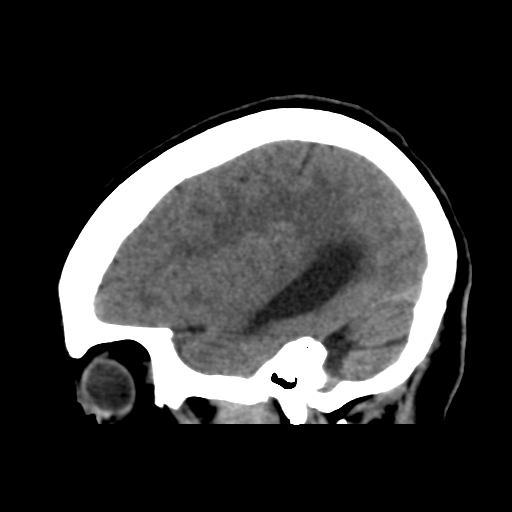 File:Central neurocytoma (Radiopaedia 65317-74346 C 40).png