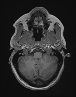 Central neurocytoma (Radiopaedia 84497-99872 Axial T1 44).jpg