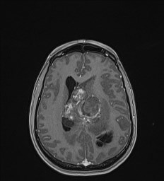 File:Central neurocytoma (Radiopaedia 84497-99872 Axial T1 C+ 97).jpg
