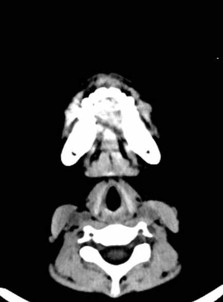 Cerebellar abscess (Radiopaedia 73727-84527 Axial non-contrast 1).jpg
